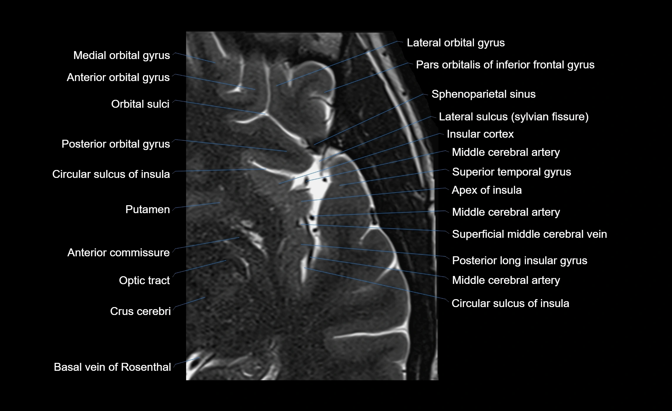Brain insula axial  anatomy 3T MRI image-img-00001-00006.webp